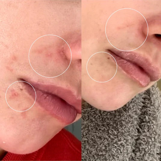 Julia Hart Skincare Shop - Acne collection